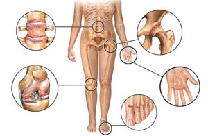 visi artrito tipai ant rankų podagrinio artrito sustava