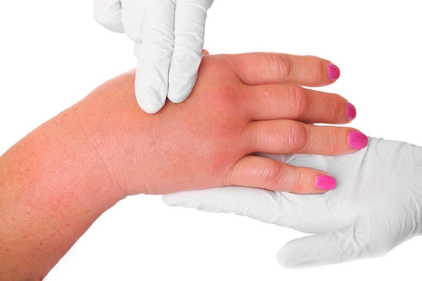 rankų pirštų sąnariai skauda ​​kai lankstymo tepalas nuo skausmo pirštų sąnario