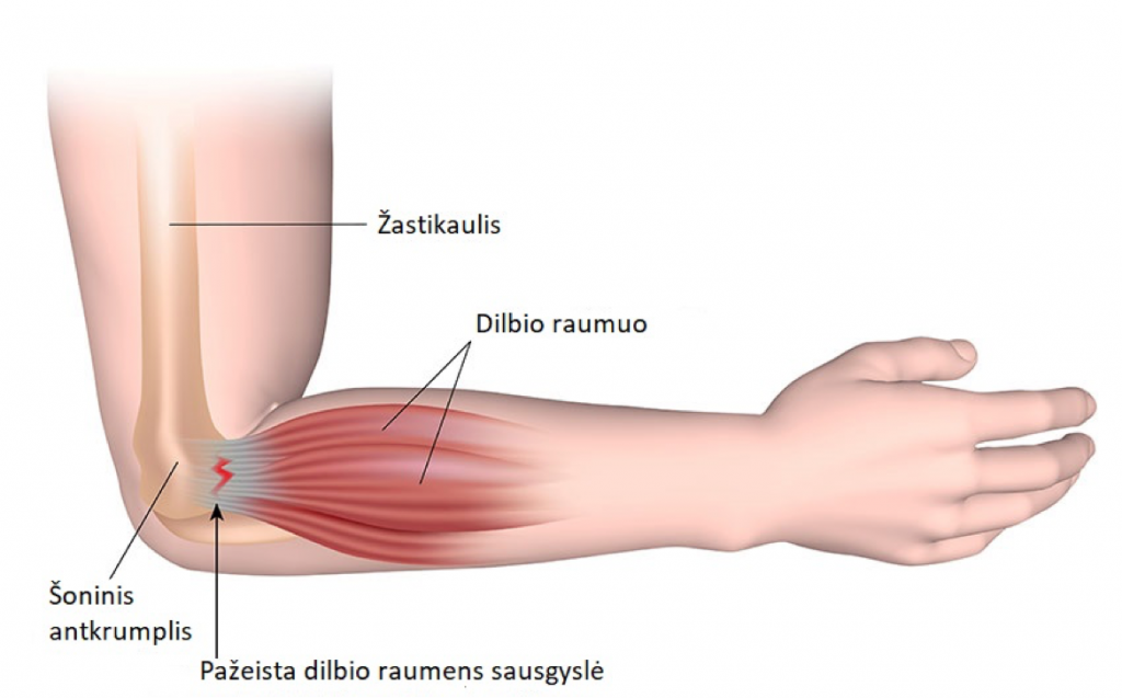 artritas iš alkūnės sąnario orlett tempimo sąnarių skausmą