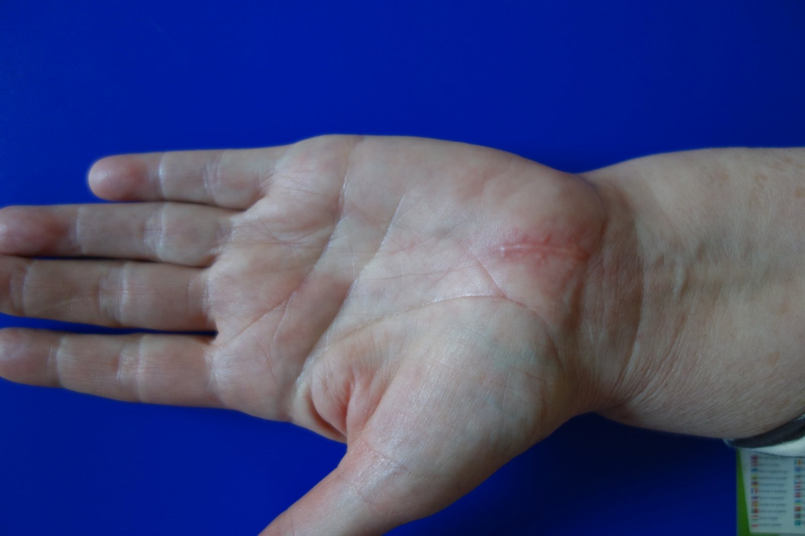 artritas piršto rankos ką daryti ilgas sąnarių skausmas