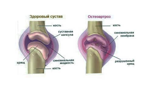 gydymas sąnarių ligomis tradicinius metodus gydymas osteoartrito 3 laipsnio koja