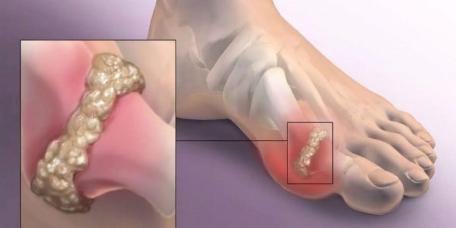 alkūnės sąnario skysčio ligas staigus pėdų skausmas