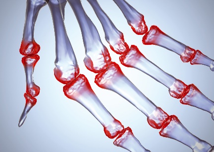 artritas artrozė liaudies gydymas liaudies gynimo priemonės su osteochondroze atsiliepimus