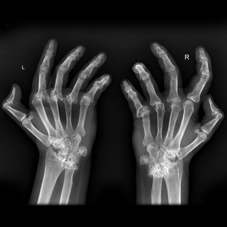 podagra hand x ray gerklės sąnarių kai darbo