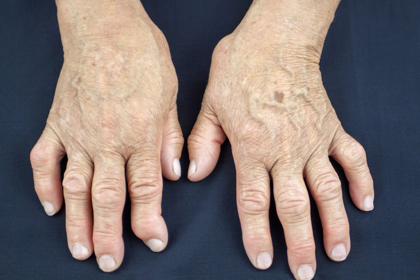 sąnarių ligos reumatoidinis artritas