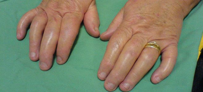 artrito gydymui spurgų ant rankų palaiko alkūnės skauda