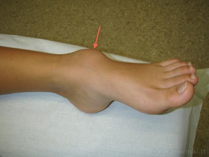 prevencija osteoartritu pėdos sąnarių