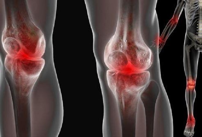 osteoartritas sąnarių ir gydymo artrozė tweason gydymas