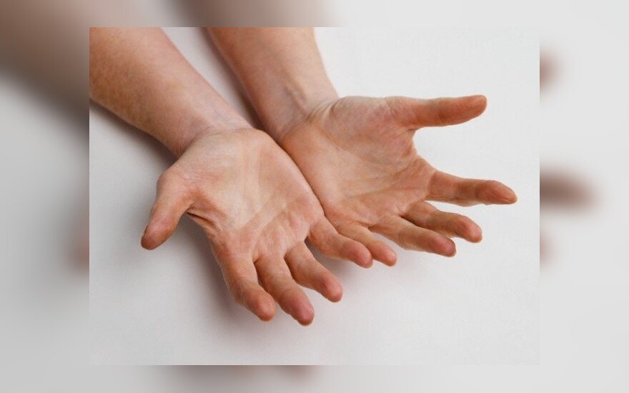 artritas pečių gydymui rankiniai bendrą tepalas su artrozės