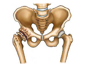 osteoartrozė nuo alkūnės jungties 2 laipsnių gydymo