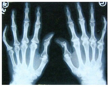 artritas ant dešinės rankos šepečiu skausmas pirštų priežastis sąnarių