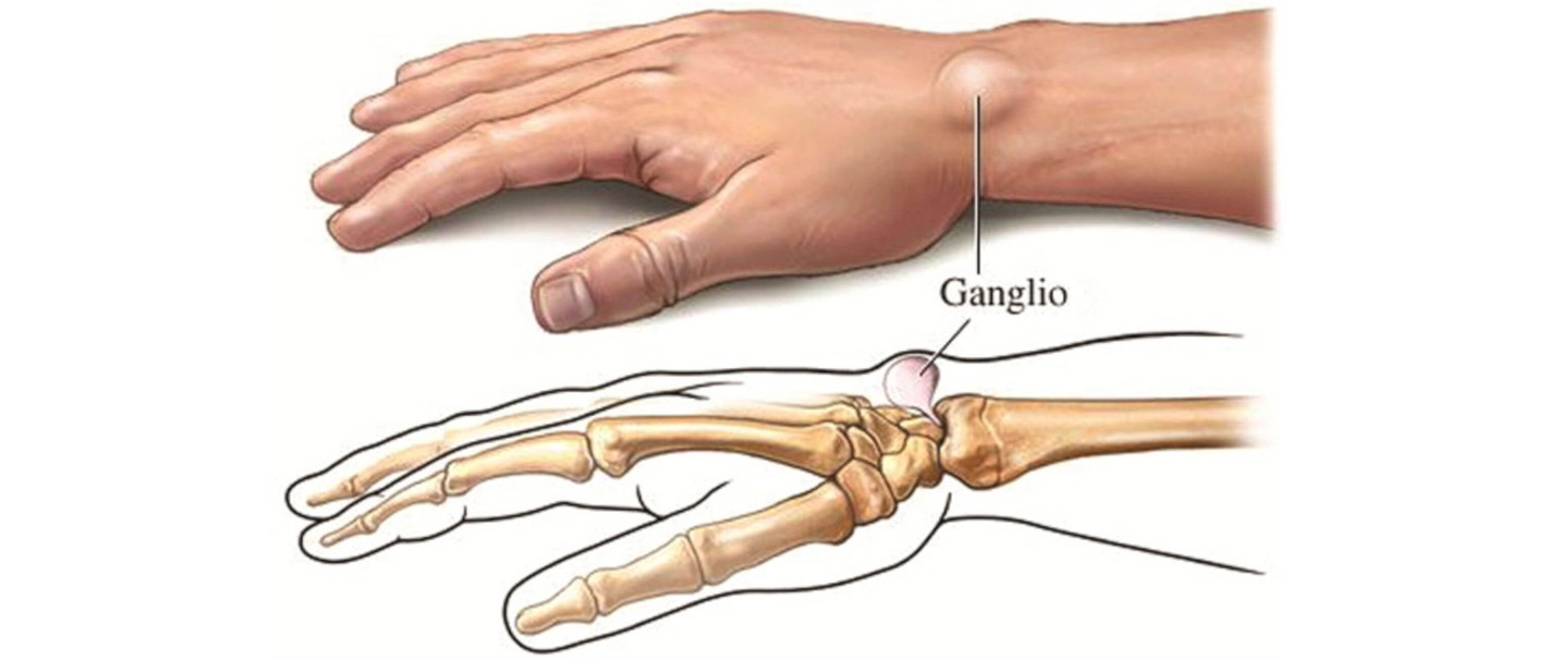 artritas piršto rankose nei tepinėlis modernių gydymo metodai artrito ir artrozės