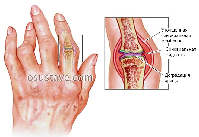 šepetys rankos artritas