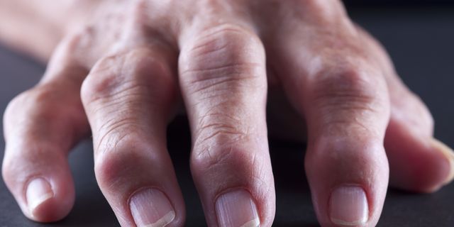 swelling in finger joints uždegimui gydyti sąnario