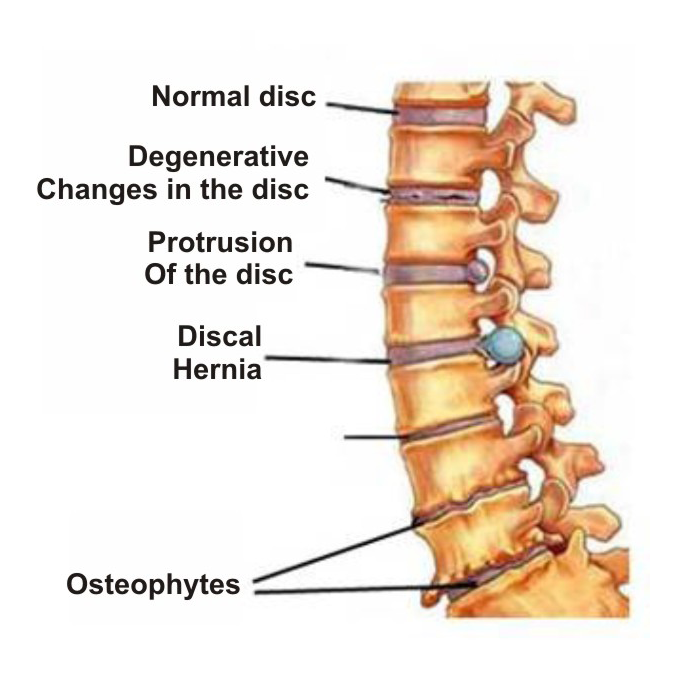 osteochondrozė simptomai skausmas minkštųjų audinių ir sąnarių