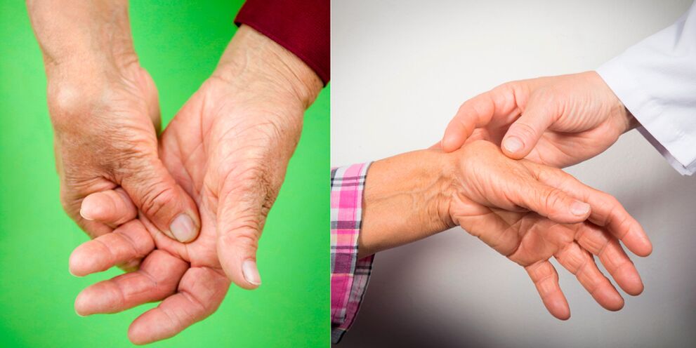 pirmieji požymiai artritu ir artrozė rankų