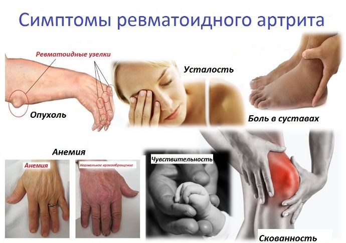 artritas pagal jungtinės skauda ir crunch sąnarių pečių