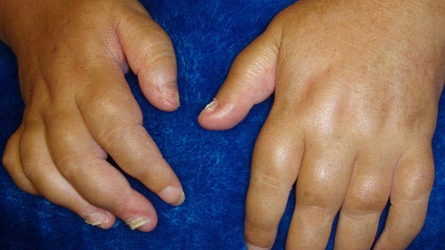 swelling between joints artritas bendros asmens
