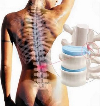 periodinė nugaros skausmas ir sąnarių liaudies gynimo priemonių gydymas