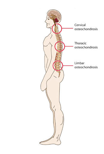 stuburo osteochondrozė ir spondilozė