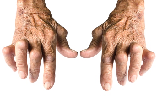 artritas rankų sustav