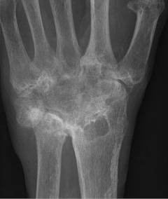 arthrisa artritas rankos