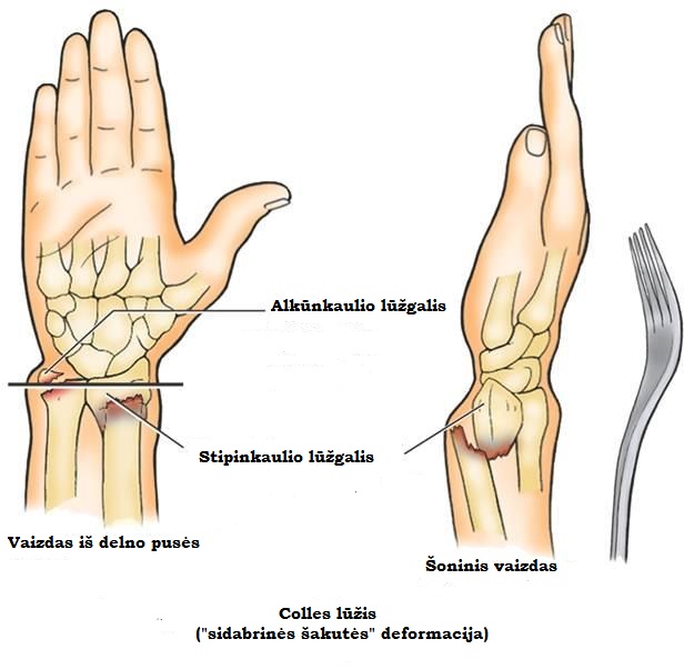 skauda sąnarius savo rankomis artrozė gydymo pėdų tradiciniai metodai