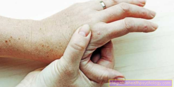 kompleksai artritas ant rankų