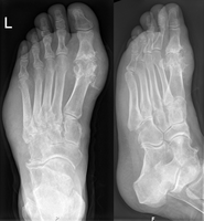 podagra hand x ray papildomų pirštų sąnario artritas
