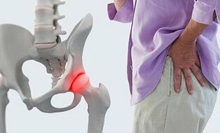 kompleksas artrozės gydymo sunkus skausmas alkūnės gydomi tepalai