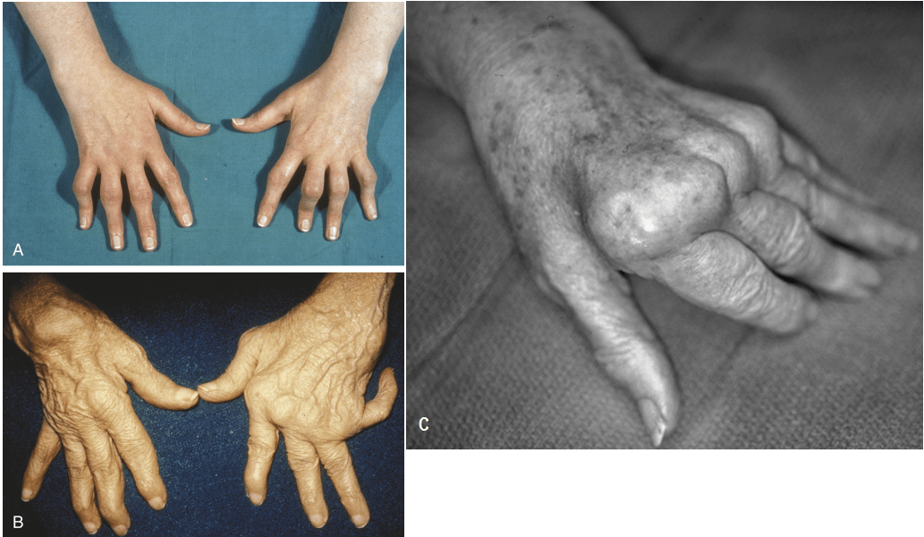 reumatinės artritas rankų šepečiai skauda klubus gydymas