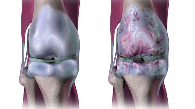 artroze simptomai osteochondrozė kojos skausmas