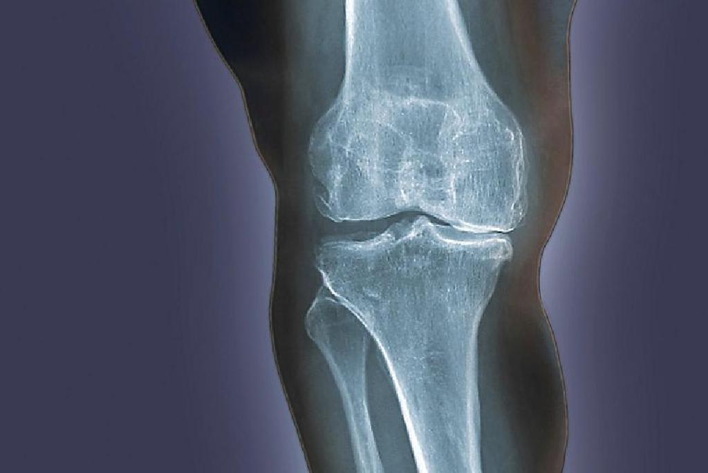 gydymas osteoartrozės peties ir alkūnės sąnario