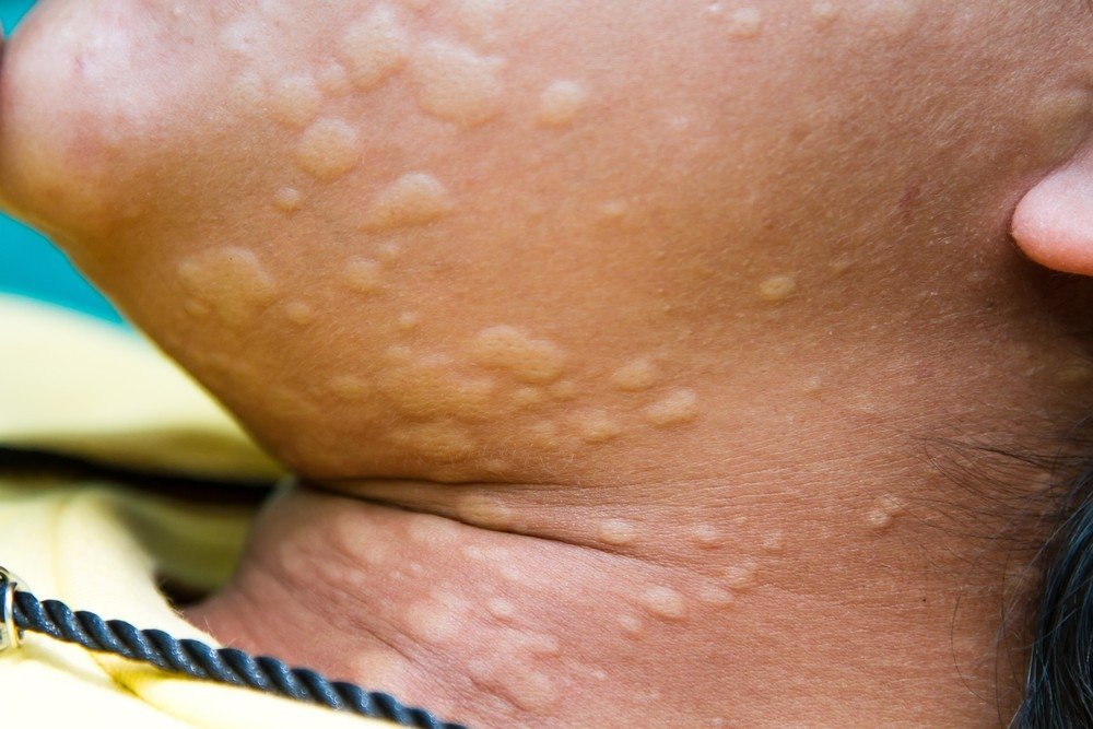 alergijos ir sąnarių liga bendra čiurnos raiščių sužalojimas pertraukos