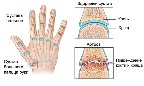 arthrisa artritas rankos