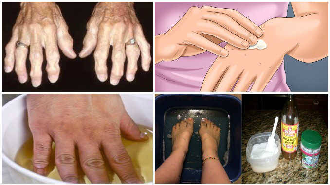 gydymas arthrisa turkijoje pirštų skausmas ranka