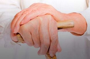 artritas pirštai gydymas