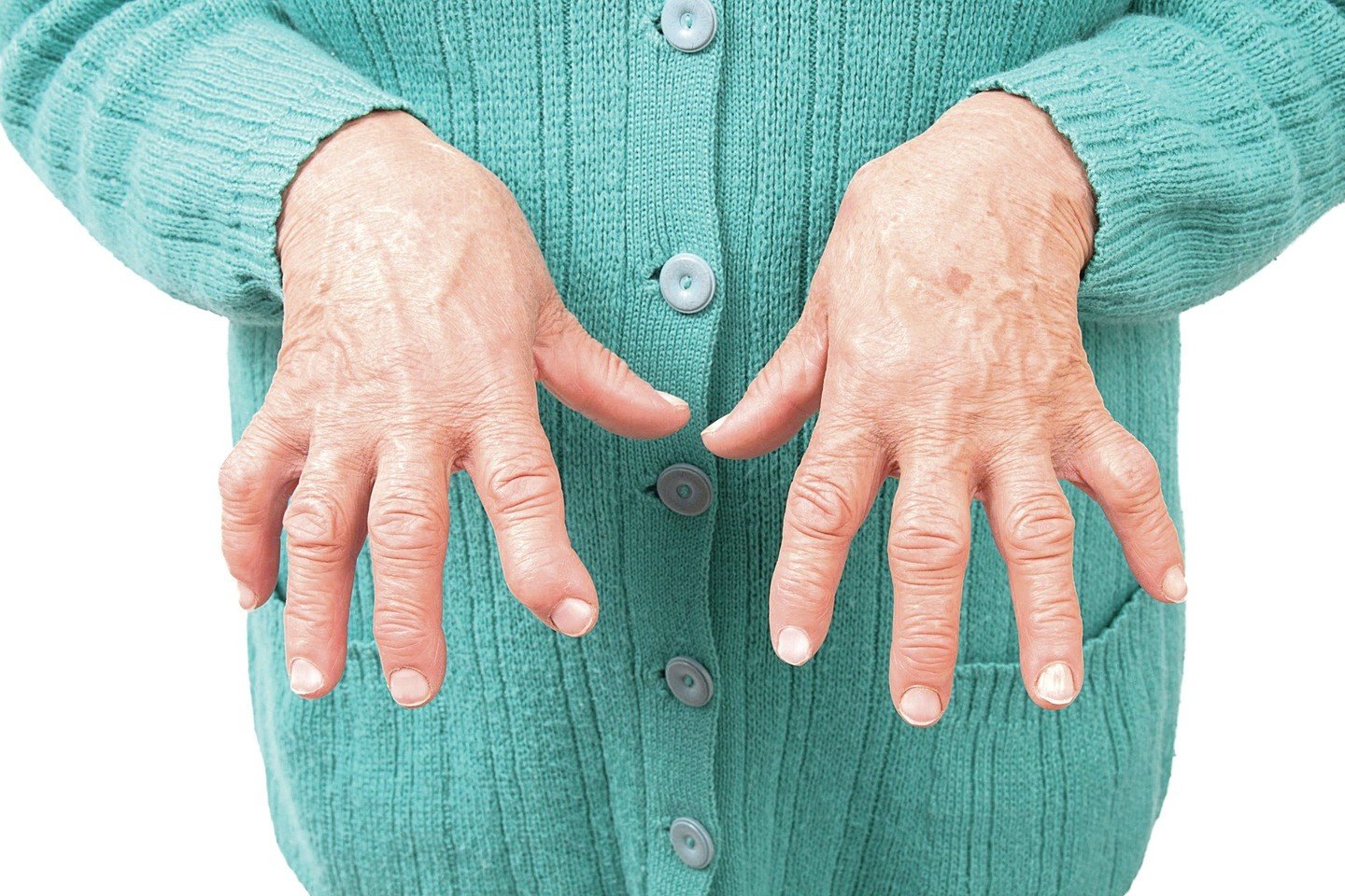 liaudies gynimo priemonės gydant osteoartritą rankas kas tepalas padeda su osteochondroze