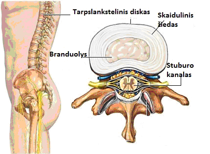 osteochondrozė skauda nugara tepalas migruoja skausmą sąnariuose ir kauluose
