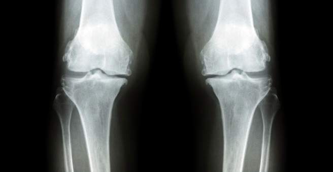 sąnarių gydymas osteoartrito