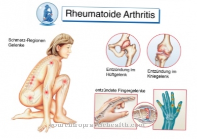 skausmas big finger reumatoidinis artritas iš peties sąnario gydymo