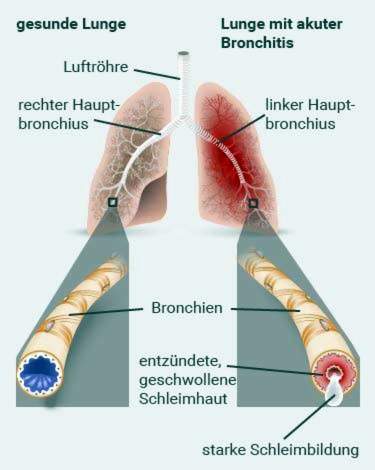 bronchitas krutines skausmas