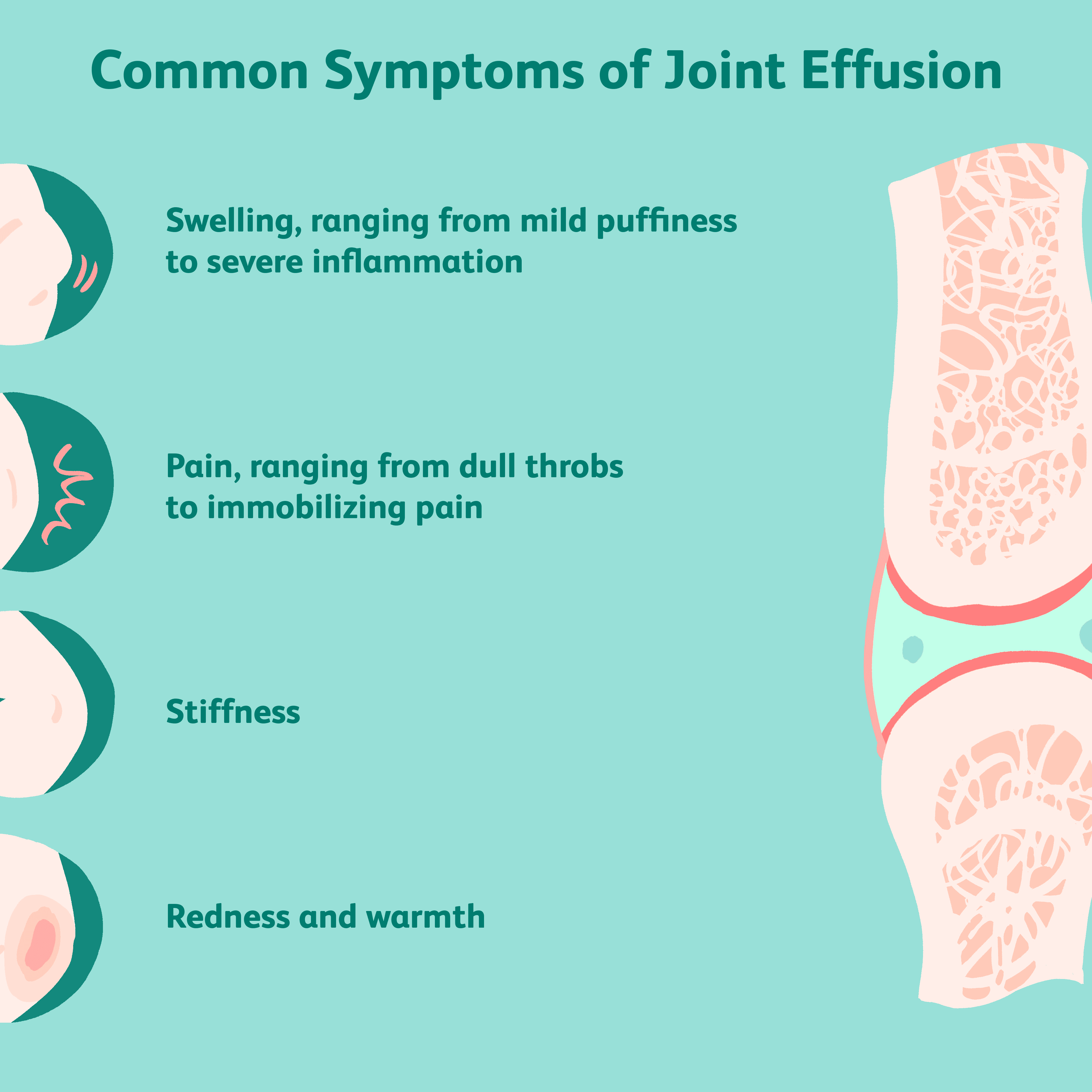 edema in joint