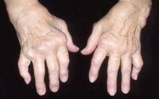 ligos nuo rankų sąnarių kreiptis į regeneravimas kremzlinės audiniais yra dėl