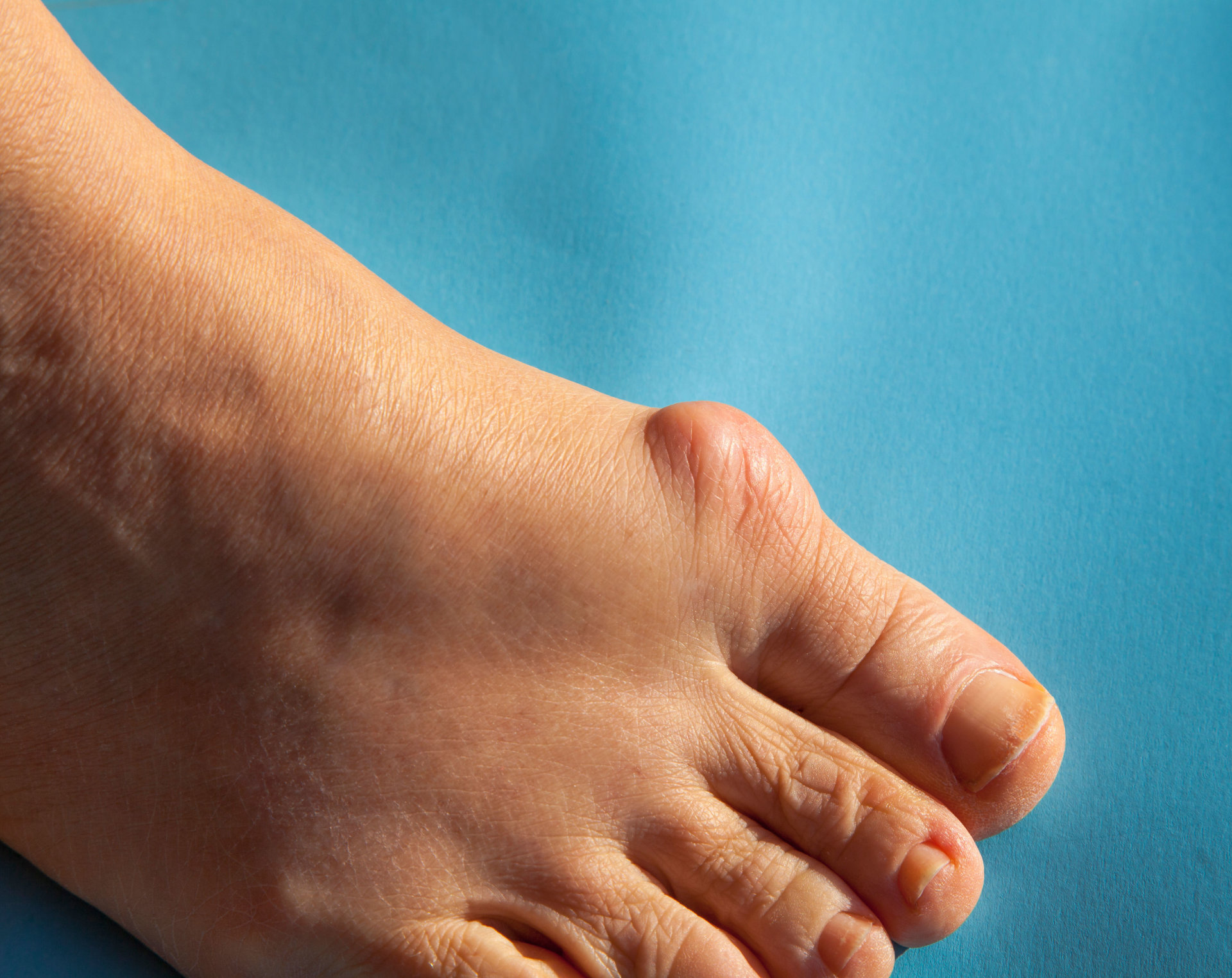 artrozė iš pėdų kaulų pėdos gydymo