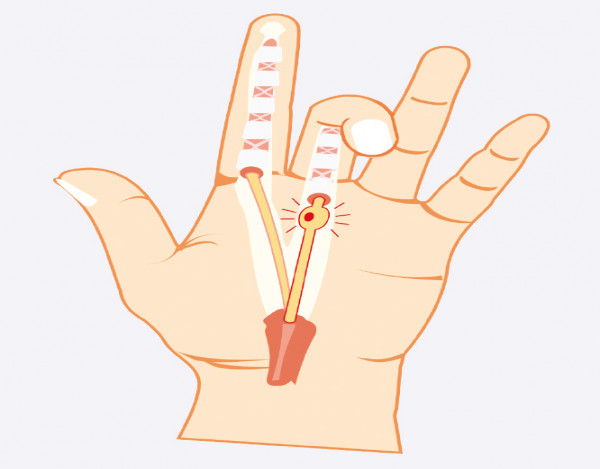 gerklės bendru didžiuoju pirštu ant rankos ką daryti psoriazinis artritas gydymas