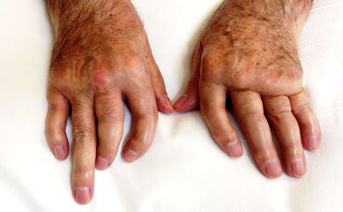 sustaines artritas liaudies sąnarių liga