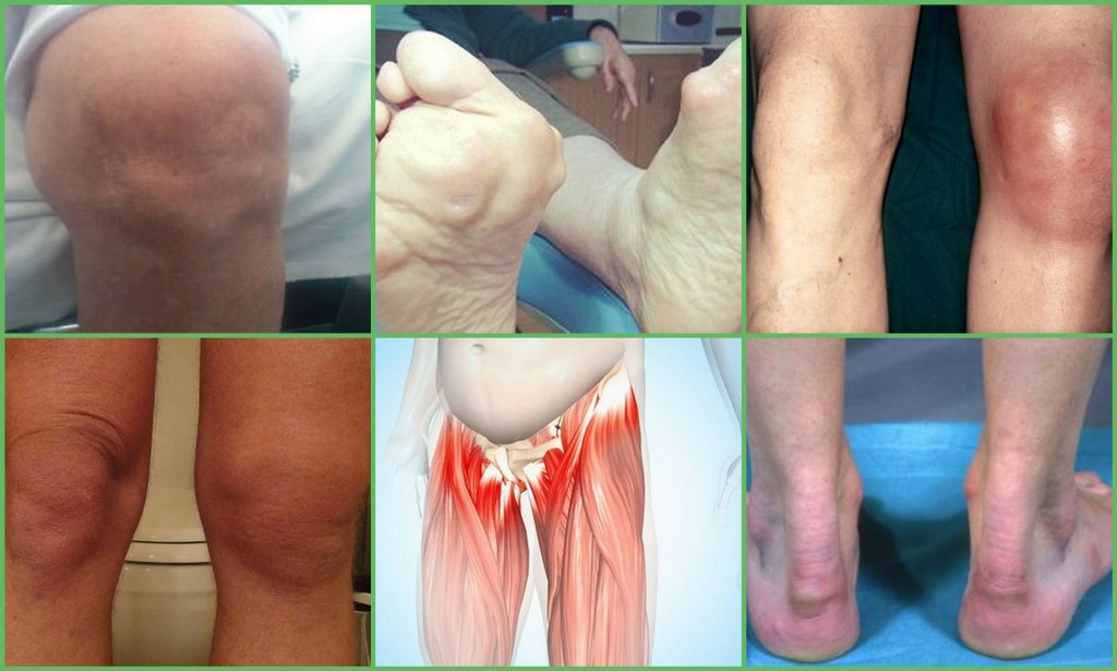 skausmas peties sąnario iš kairės rankos ir alkūnės tepalas artrozės kojų gydymui