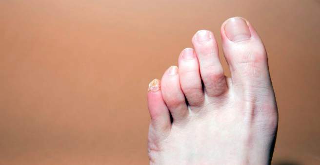 šis mažas pėdos pėdos artritas