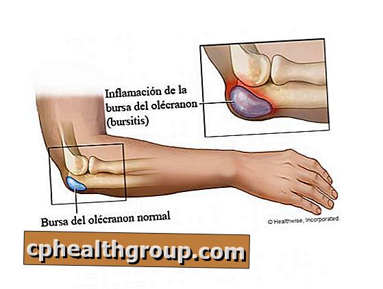 rheumatoid arthritis symptoms
